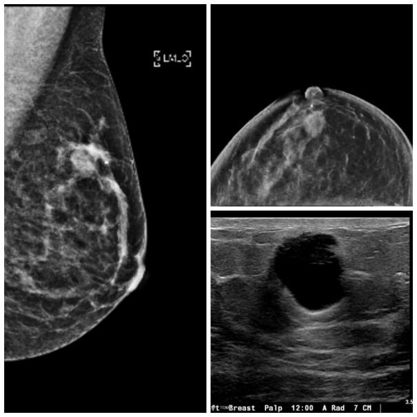 Scans Showing Breast Cancer